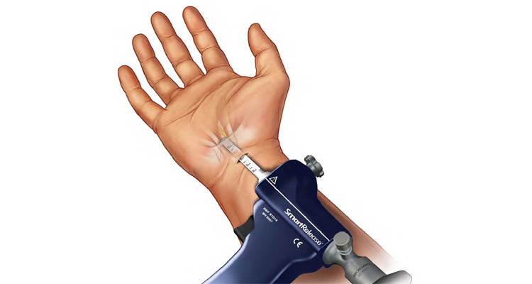 ΚΑΡΠΙΑΙΟΣ ΣΩΛΗΝΑΣ