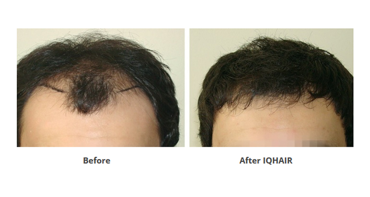 Μεταμόσχευση μαλλιών